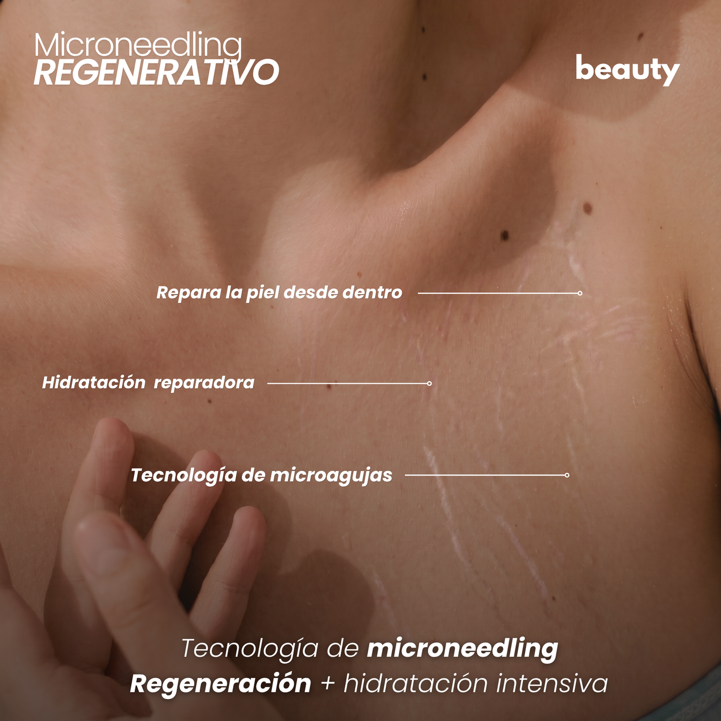 Tratamiento Anti Estrías | beauty™️