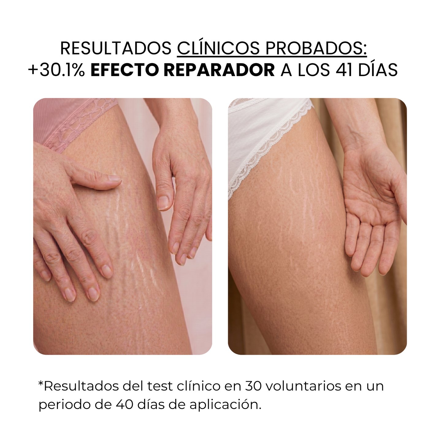 Tratamiento Anti Estrías | beauty™️