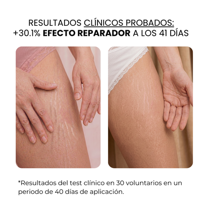 Tratamiento Anti Estrías | beauty™️