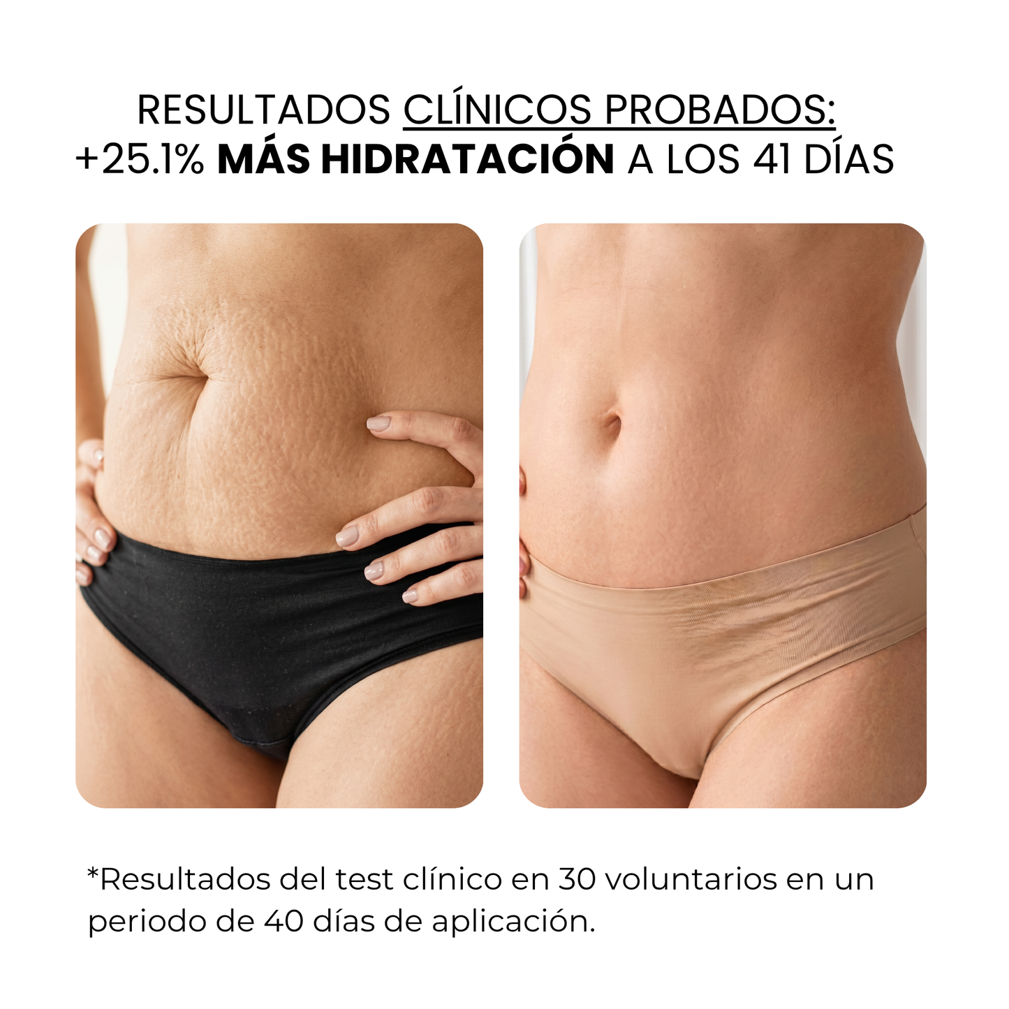 Tratamiento Anti Estrías | beauty™️