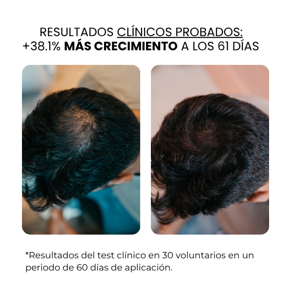 Crecimiento Capilar Masculino | beauty™️