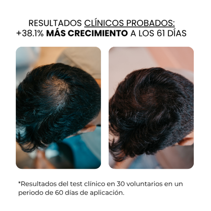 Crecimiento Capilar Masculino | beauty™️
