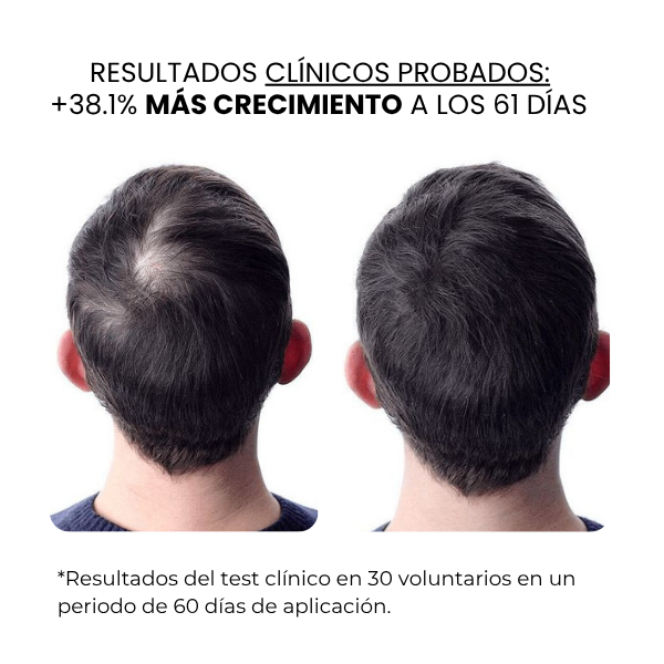 Crecimiento Capilar Masculino | beauty™️